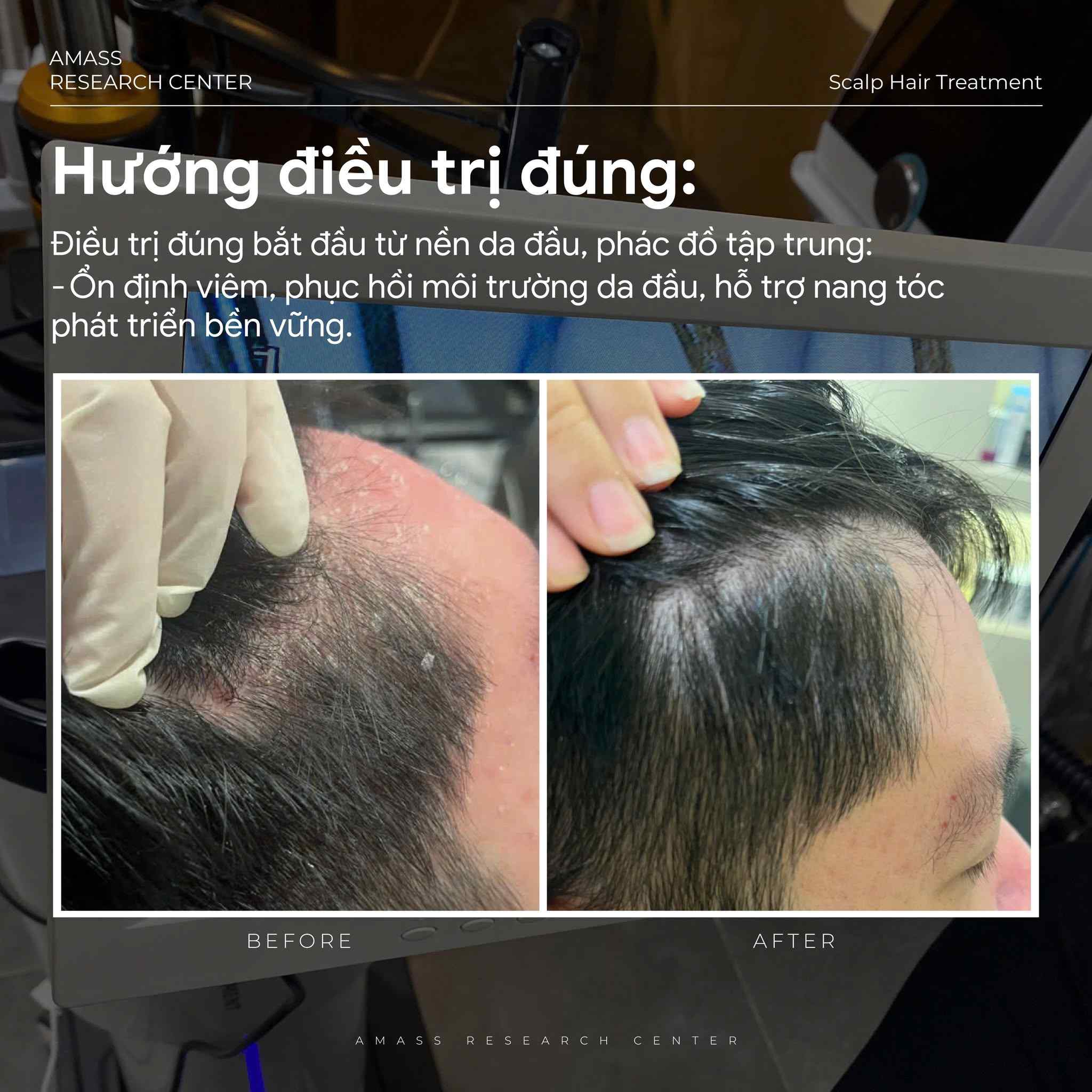 Amass điều trị rụng tóc