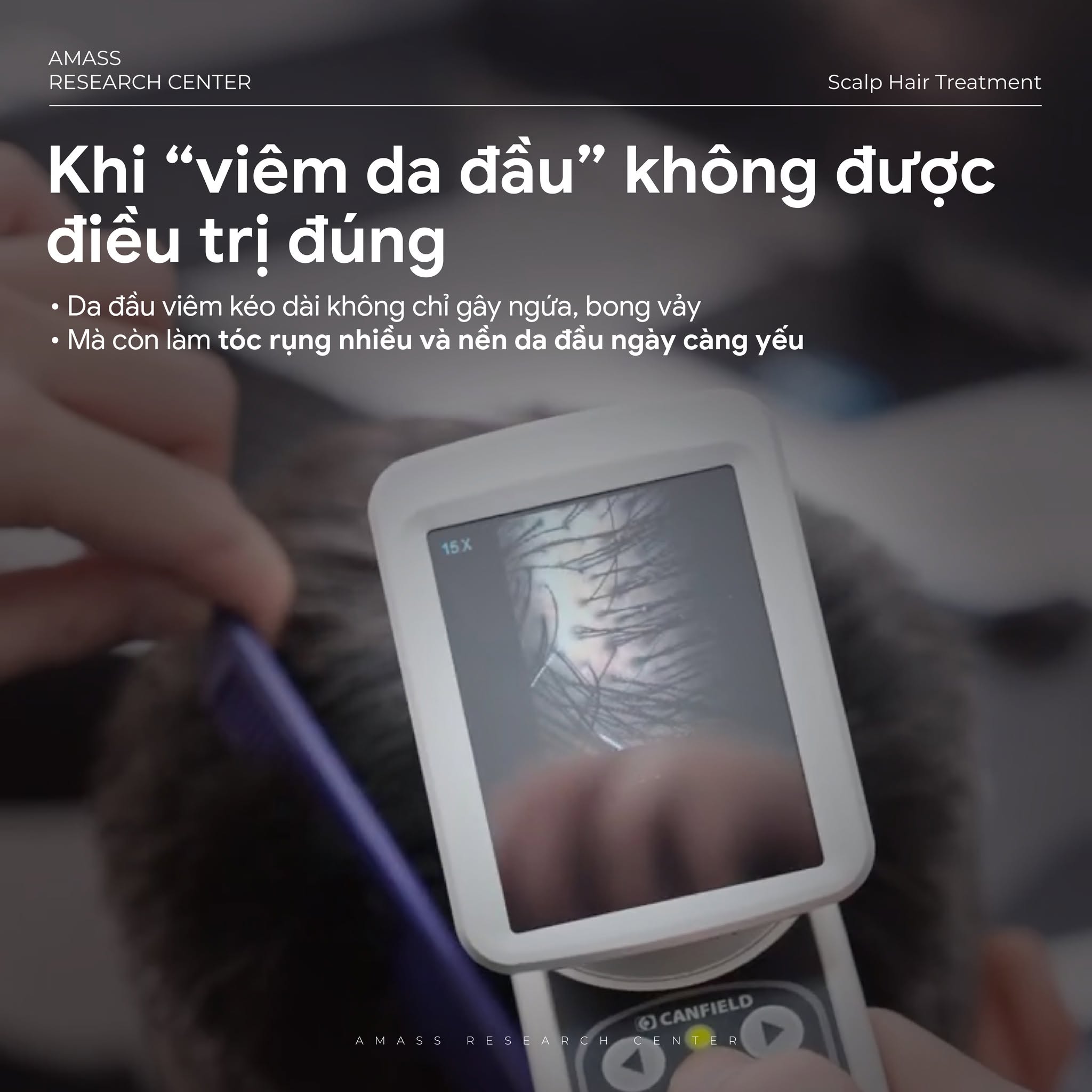 Viêm da đầu: Nguyên nhân khiến tóc rụng kéo dài