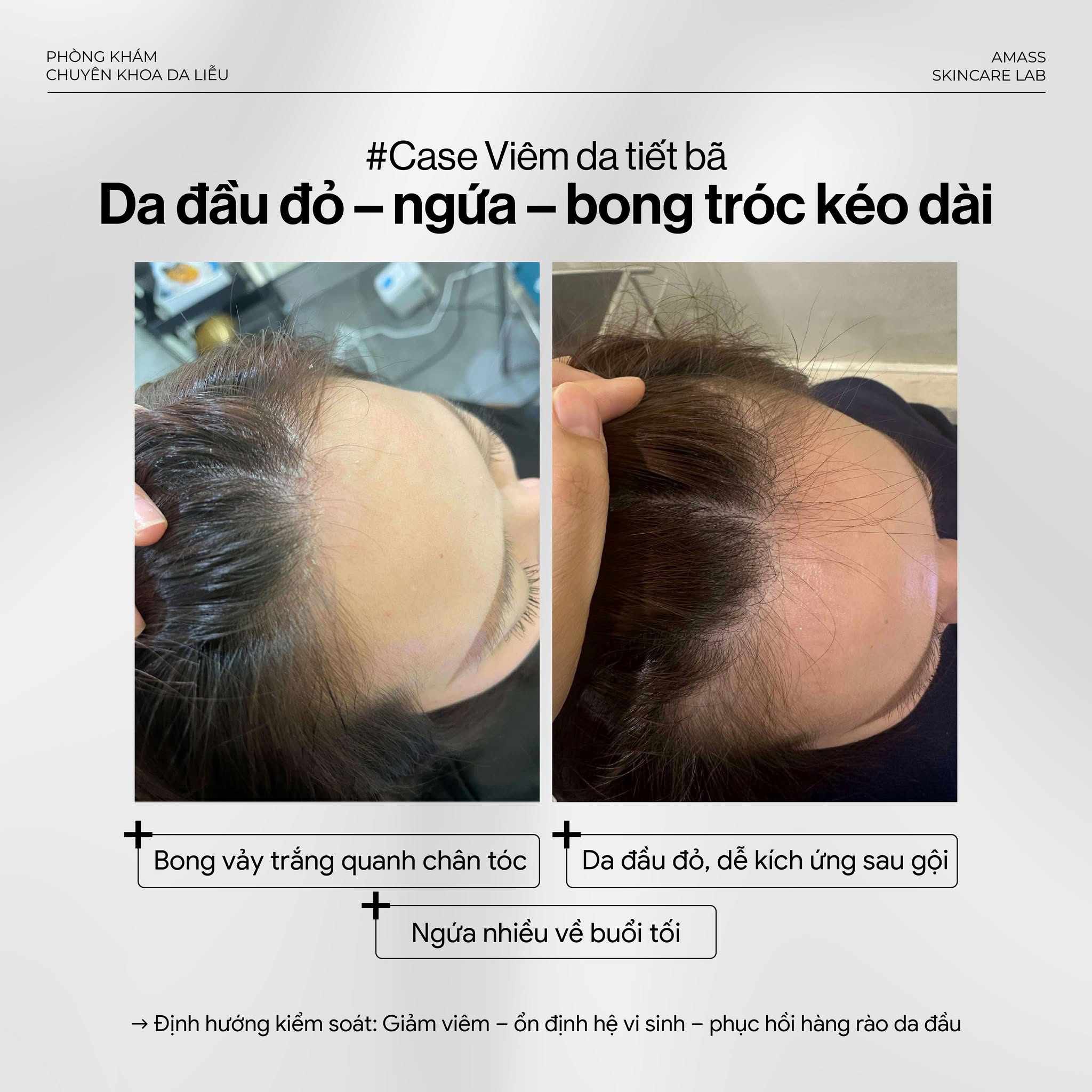 Cách Xử Lý Dứt Điểm Gàu Mảng Và Da Đầu Nhanh Bết