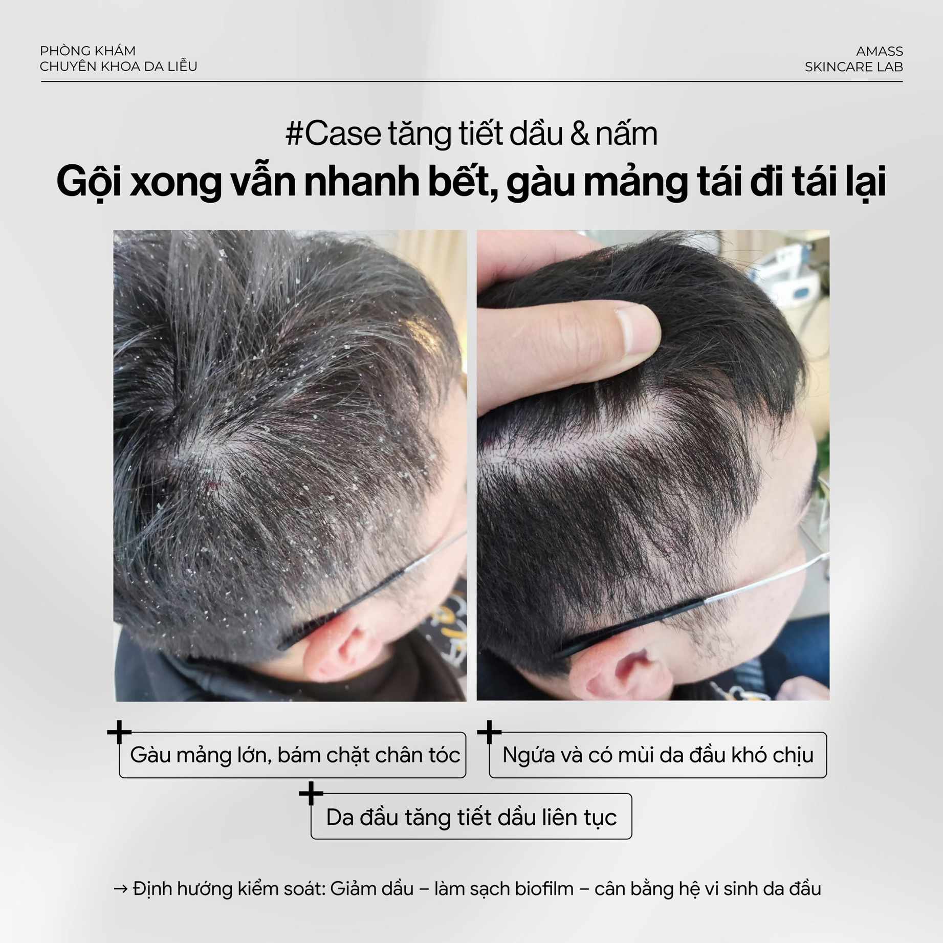 Mọc tóc
