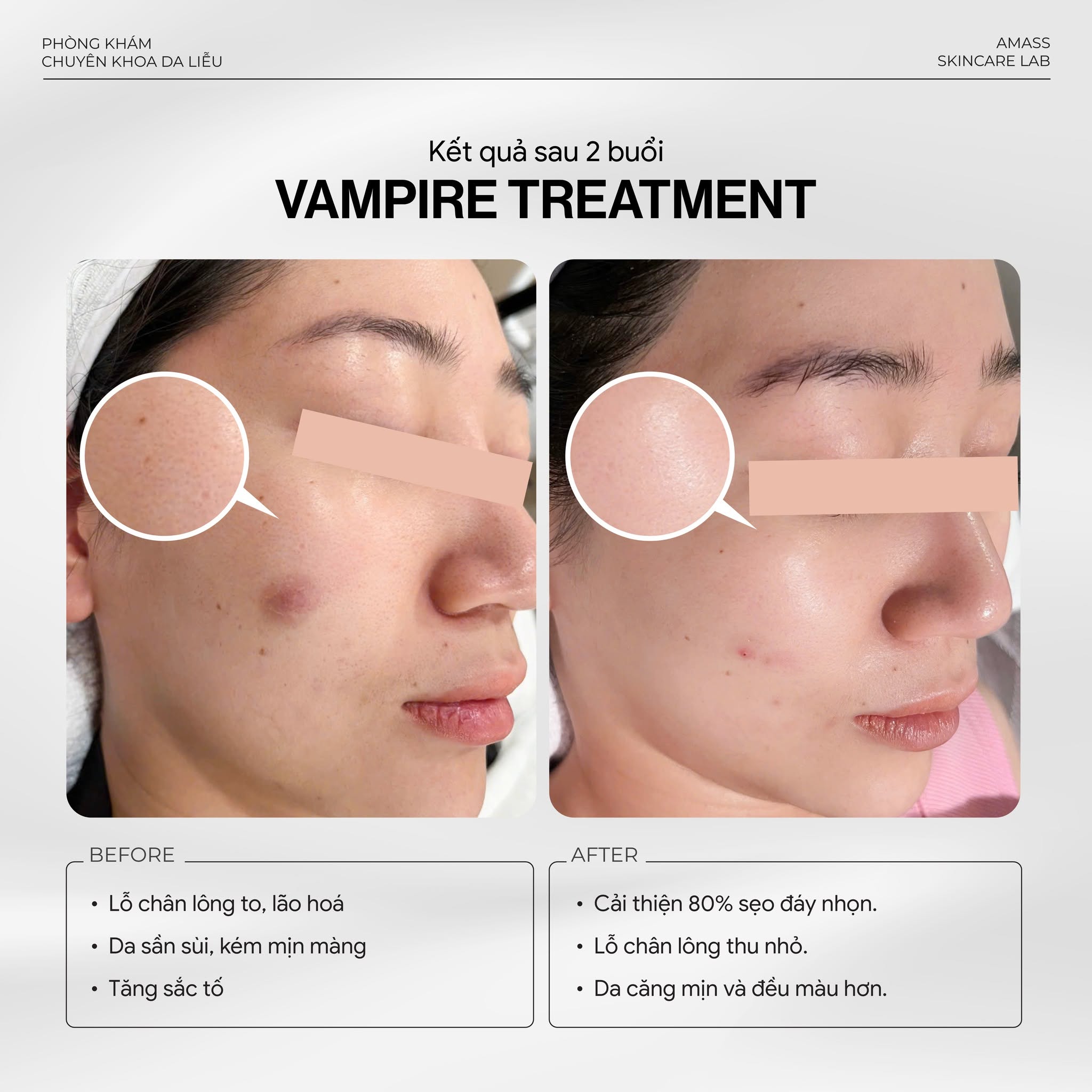 Trị sẹo đáy nhọn và lỗ chân lông to với Vampire Treatment