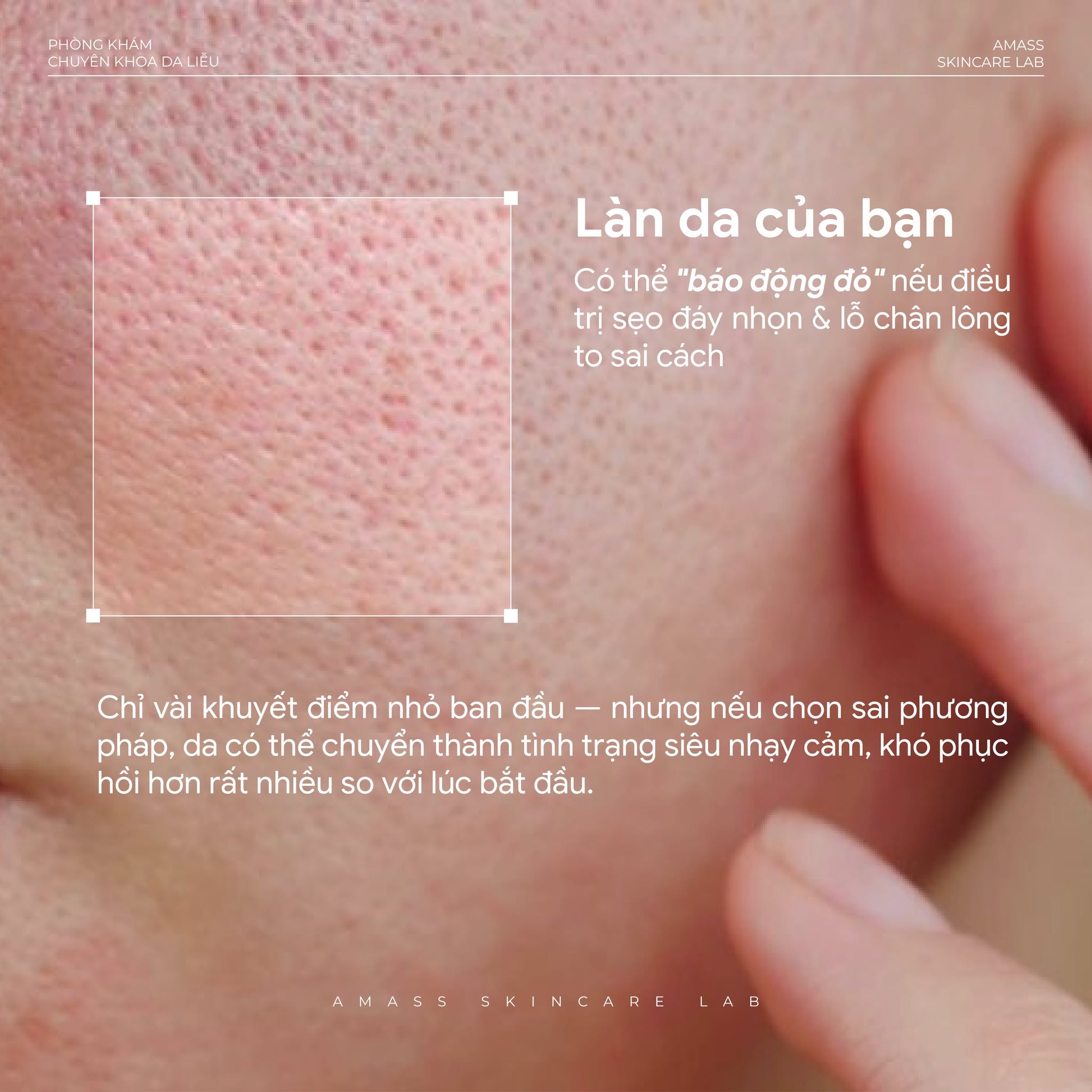 Bề mặt da cải thiện sau điều trị sẹo đáy nhọn, lỗ chân lông se khít hơn, da mịn và đều màu hơn sau quá trình phục hồi.