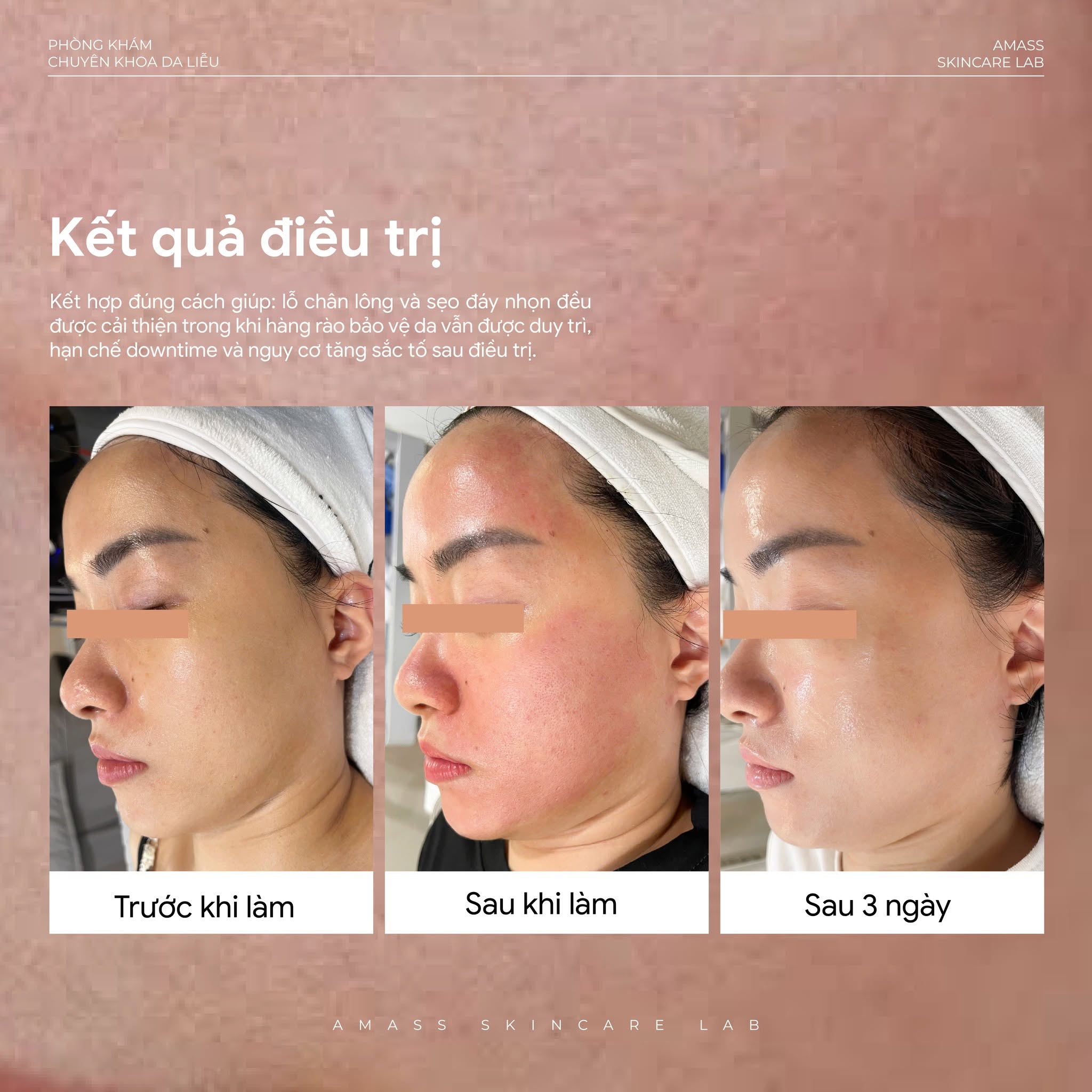 Cận cảnh kết quả điều trị sẹo đáy nhọn và lỗ chân lông to bằng phác đồ kết hợp, giúp cải thiện kết cấu da và tăng độ mịn màng.