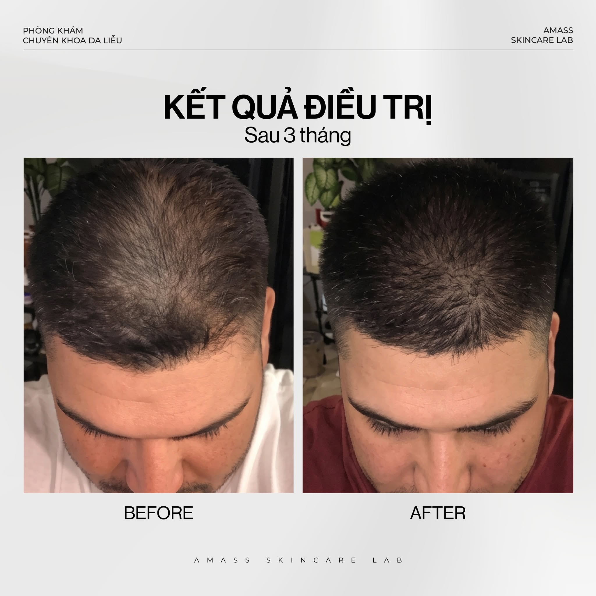 Kết quả điều trị rụng tóc nội tiết sau 3 tháng với hình ảnh trước và sau cho thấy mật độ tóc vùng đỉnh đầu cải thiện rõ rệt.