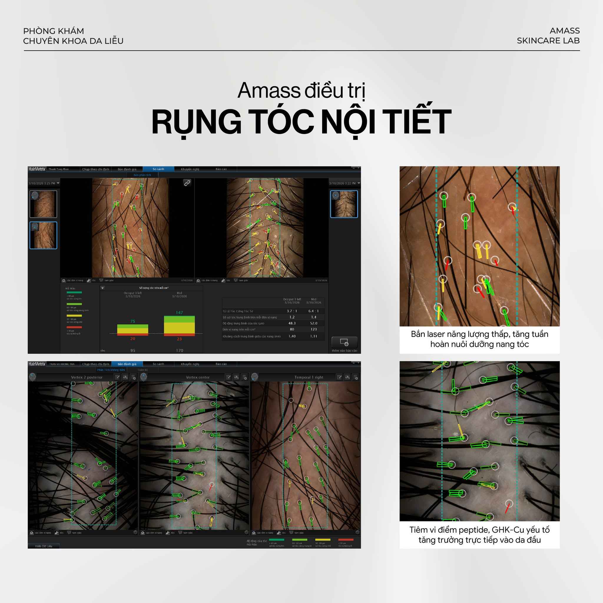 Điều trị rụng tóc nội tiết sau 3 tháng tại AMASS