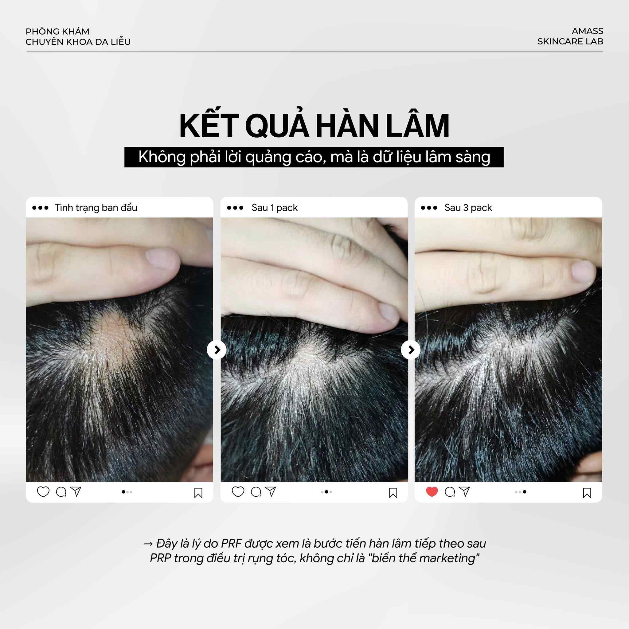 PRF Điều Trị Rụng Tóc Hói Đầu Cơ Chế Mới Hiệu Quả
