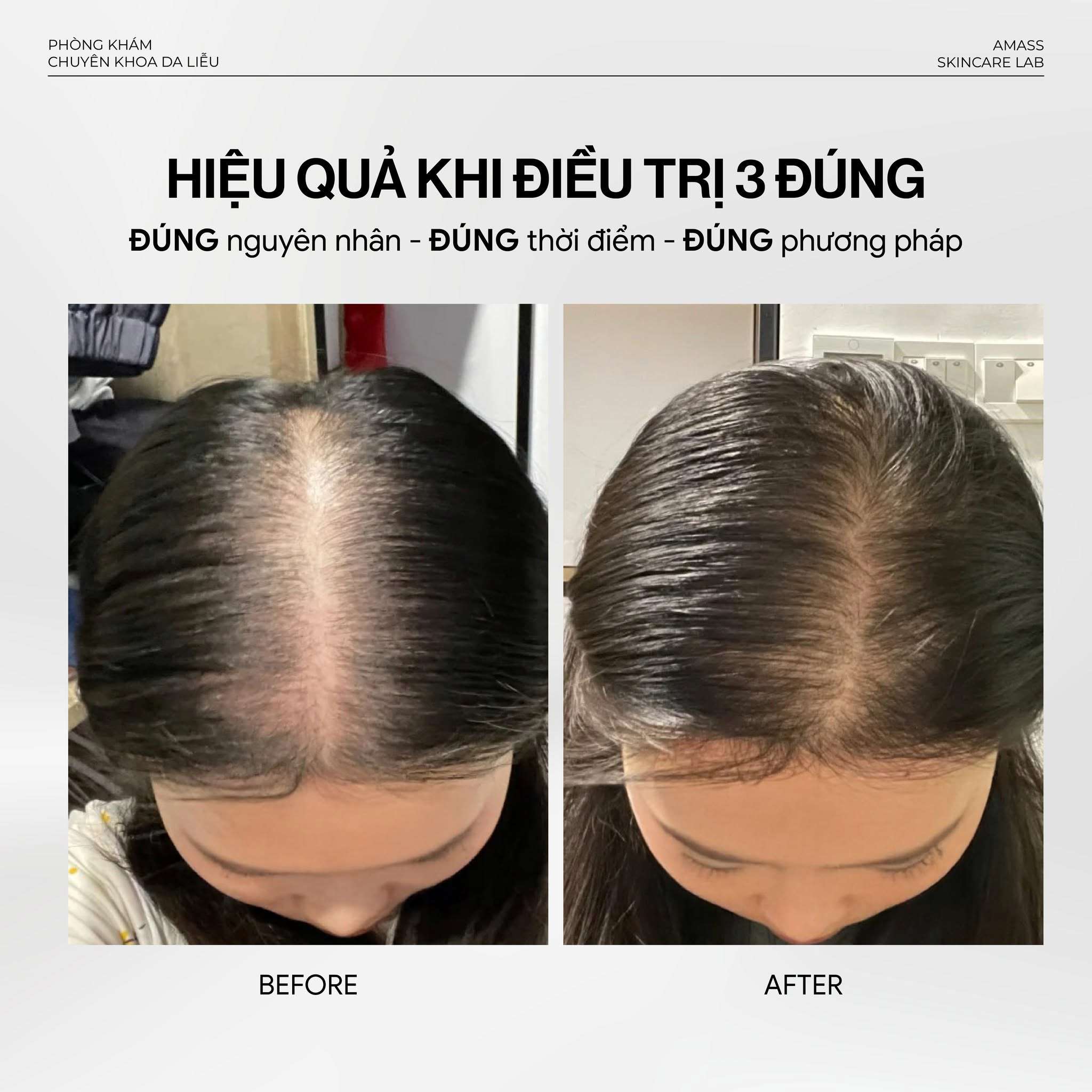 Ket qua truoc va sau khi dieu tri rung toc sau sinh hieu qua