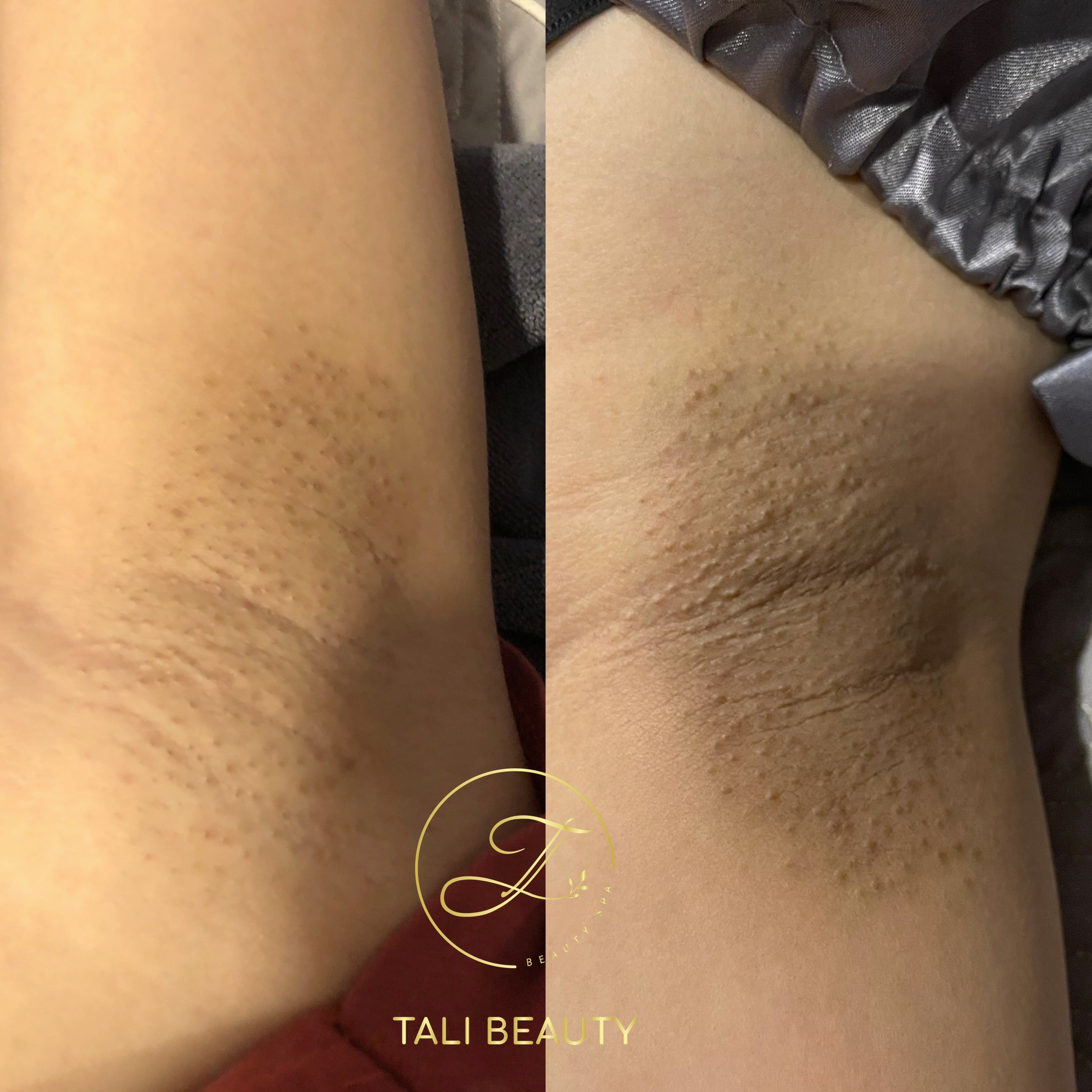 TRAINING TRỊ THÂM BODY SÁNG MỊN DA